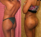 butt augmentation