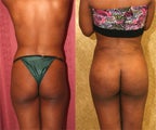 butt lift