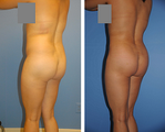 Buttocks Enhancement