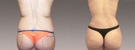 Fat Transfer/Buttock Reshaping