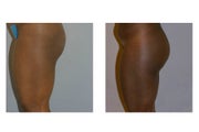 Buttock Implant Augmentation