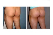 Butt Implants