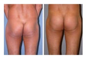 Butt Implants