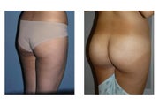 Butt Implants