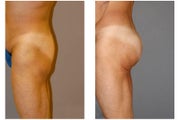 Butt Implants