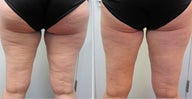 Cellulaze Laser Cellulite Reduction