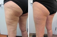 Cellulaze Laser Cellulite Reduction