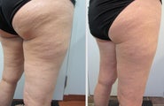 Cellulaze Laser Cellulite Reduction