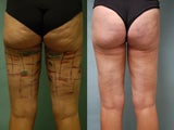 Cellulaze anti-cellulite treatment of buttocks and thighs