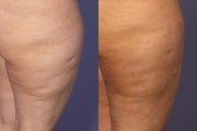 Cellulaze