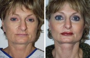 Cheek and Chin Implants, Neck Lift