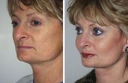 Cheek and Chin Implants, Neck Lift