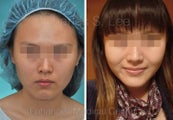 Chin Augmentation, Cheek, Jaw