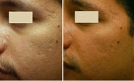 Acne Scarring Correction
