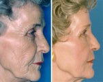 Chemical Peel