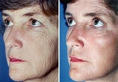 Chemical Peel