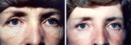 Chemical Peel