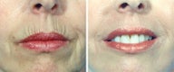 Chemical Peel
