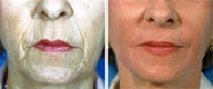Chemical Peel