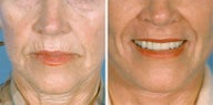 Chemical Peel