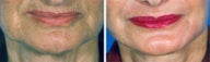 Chemical Peel