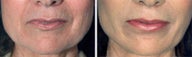Chemical Peel