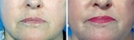 Chemical Peel