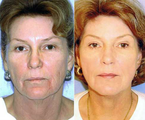 Chemical Peel