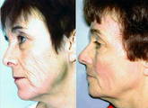 Chemical Peel