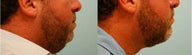Chin Implant (Alloplastic Chin Augmentation)