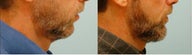 Chin Implant (Alloplastic Chin Augmentation)