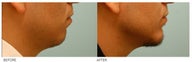 Chin Implant (Alloplastic Chin Augmentation)