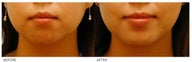 Chin Implant (Alloplastic Chin Augmentation)