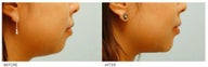 Chin Implant (Alloplastic Chin Augmentation)