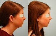 Chin Implant (Alloplastic Chin Augmentation)
