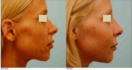 Revision/Corrective Rhinoplasty and Cheek Augmentation