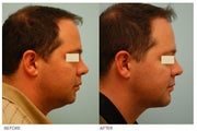 Neck Rejuvenation