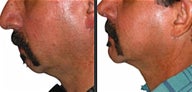 Chin Augmentation