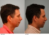 Chin Implant