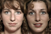 Rhinoplasty and chin implant