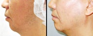 Chin Augmentation
