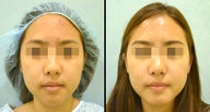 Chin Augmentation
