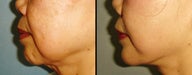 Chin Augmentation