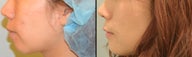 Chin Augmentation