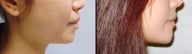 Chin Augmentation