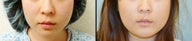 Chin Augmentation
