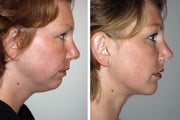 Liposuction of chin with a chin implant