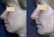Chin Augmentation