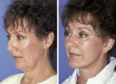 Facelift