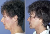 Facelift